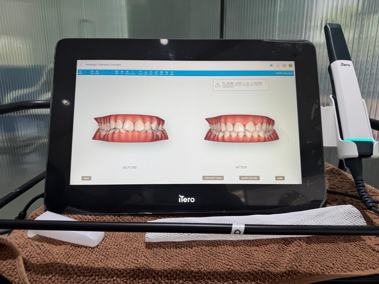 self lingual braces in surat gujarat