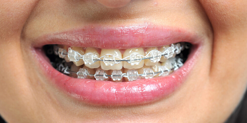 best orthodontics in vesu surat