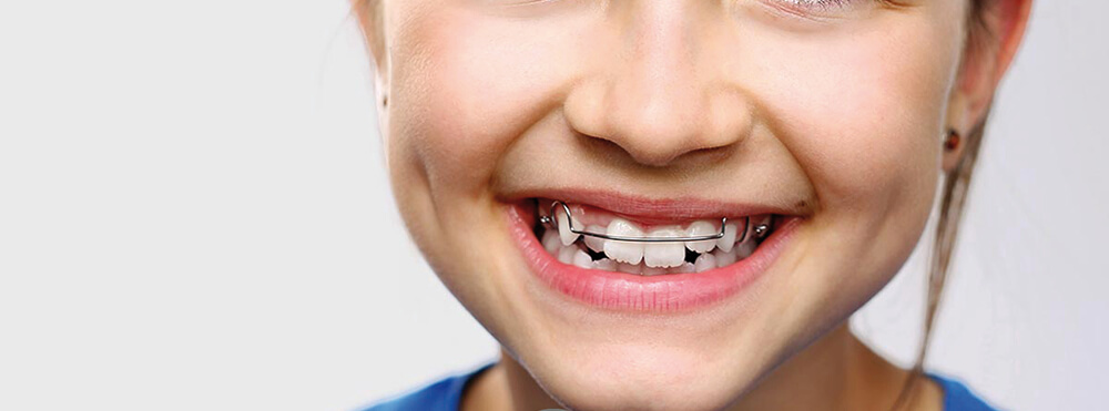 braces treatment in vesu surat