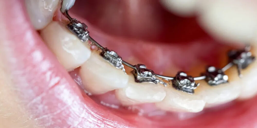 child orthodontist in surat