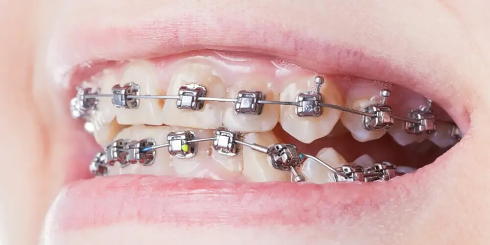 adult orthodontist in surat